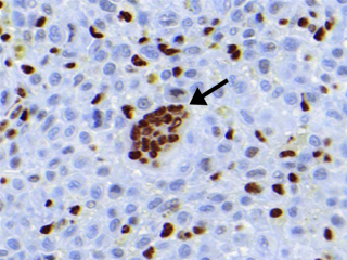 sarcoma_science