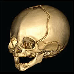 midline-craniosynostosis