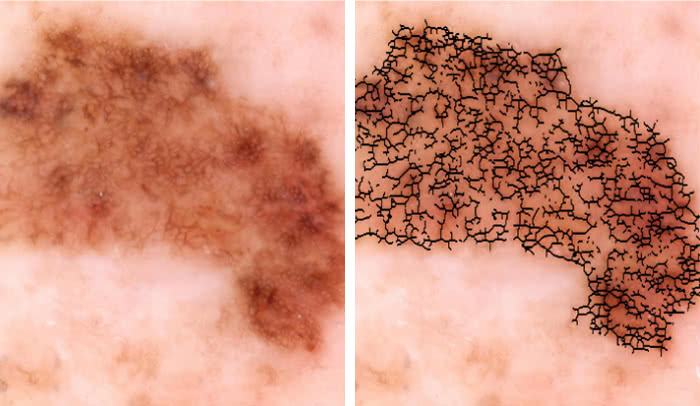 Malignant or benign?: An image of a skin growth is processed by a new technology to extract quantitative data, such as irregularities in the shape of pigmented skin, which could help doctors determine if it’s cancerous. 