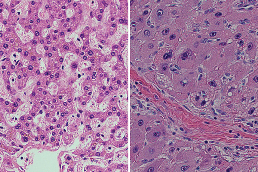 Cross-section of a normal human liver (left) and one affected by fibrolamellar carcinoma