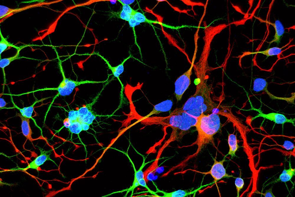 Huntington's neurons