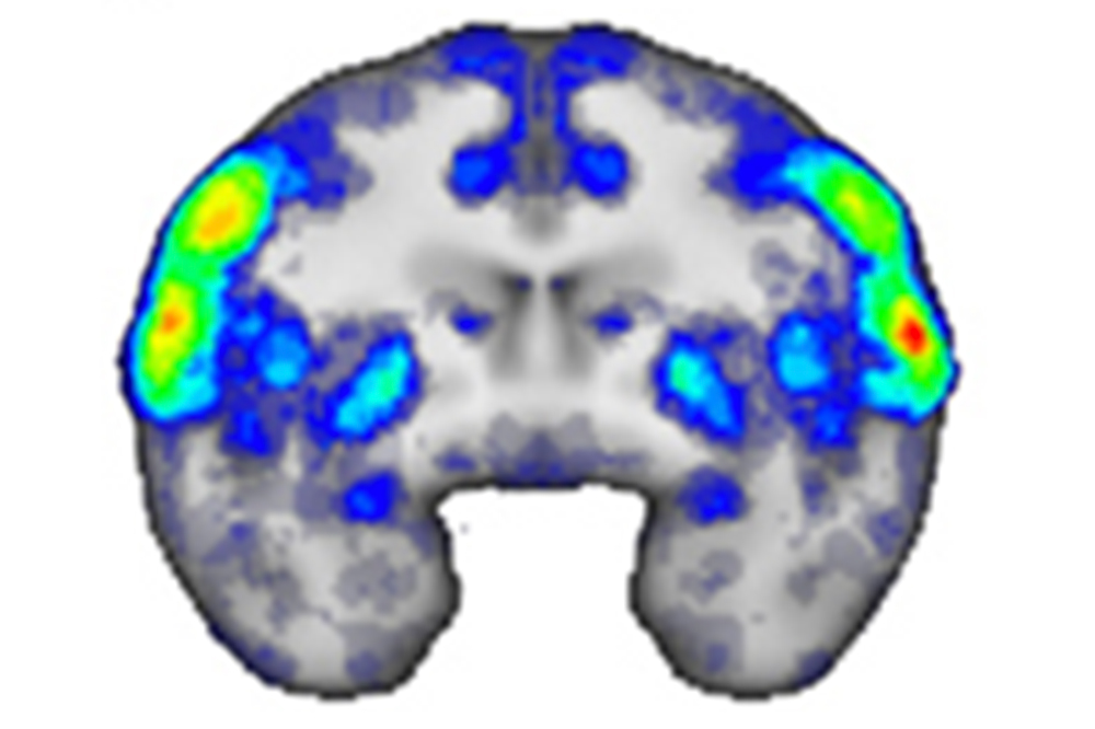 MRI Brain Scan