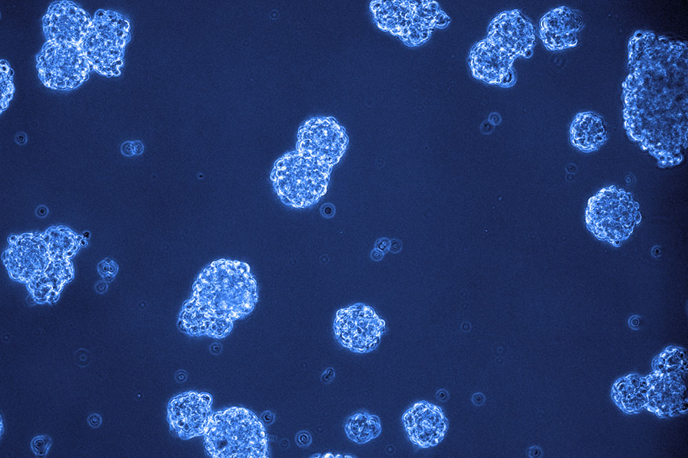 DIPG cells, pictured here, are generally resilient and replicate rapidly. With a dose of MI-2, however, the cells abruptly die. 