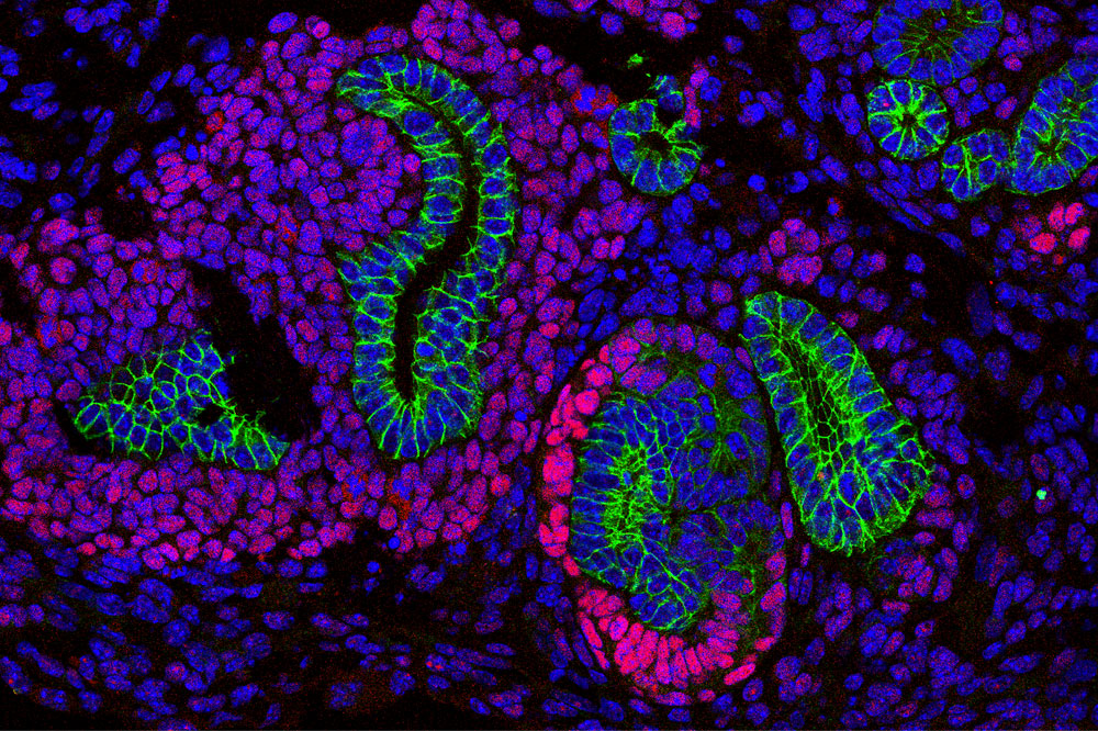 Wilms tumor