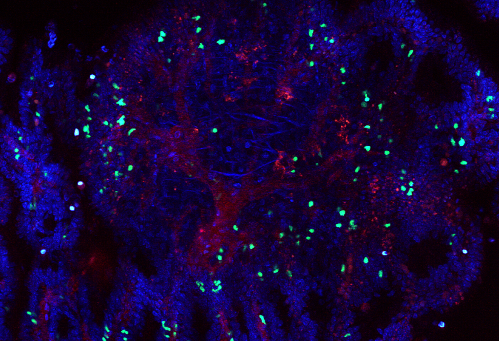 gd cells with tumor