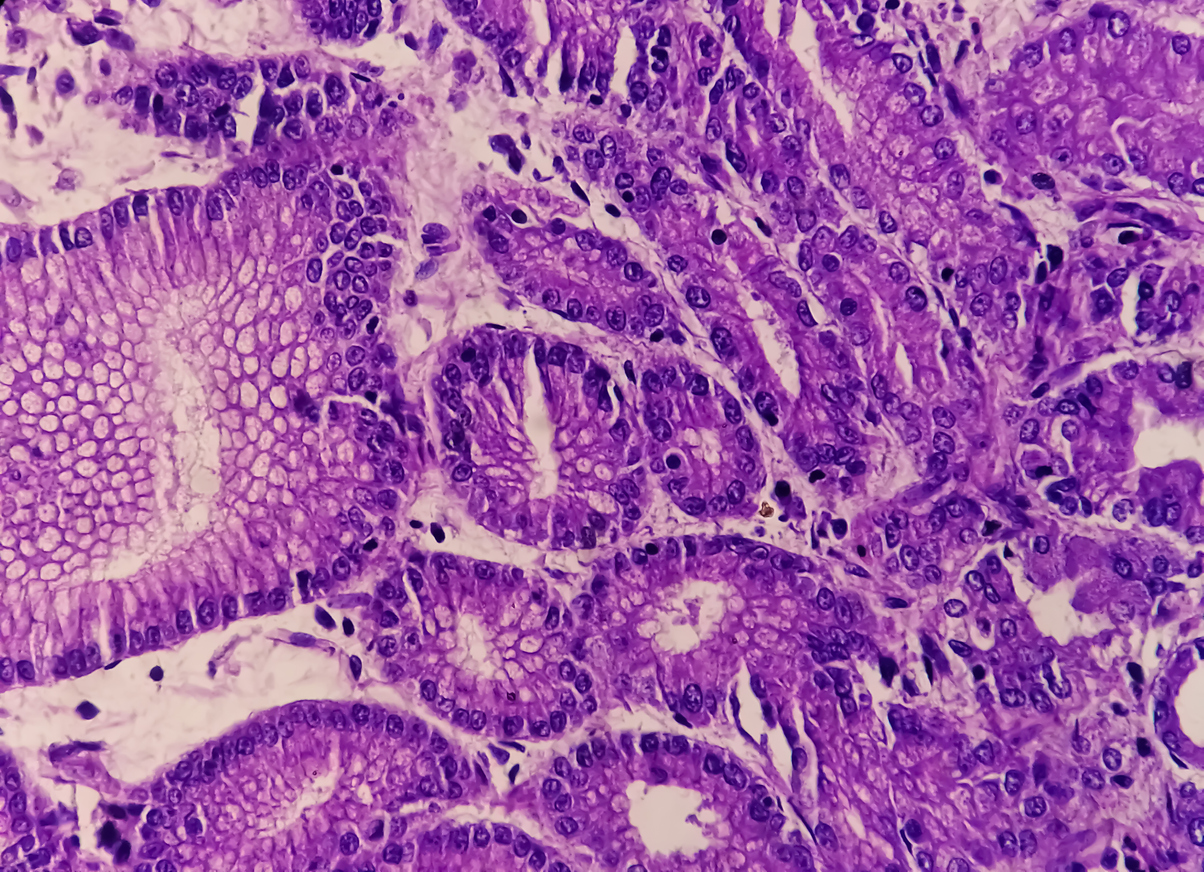 Adenocarcinoma of stomach