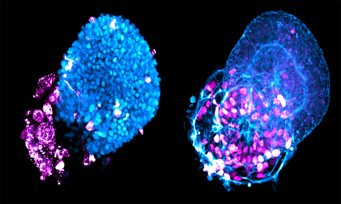 lung cells being infected by SARS-CoV-2