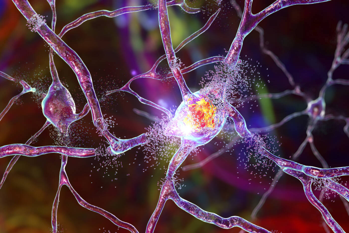 3D illustration of the destruction of neurons in the dorsal striatum