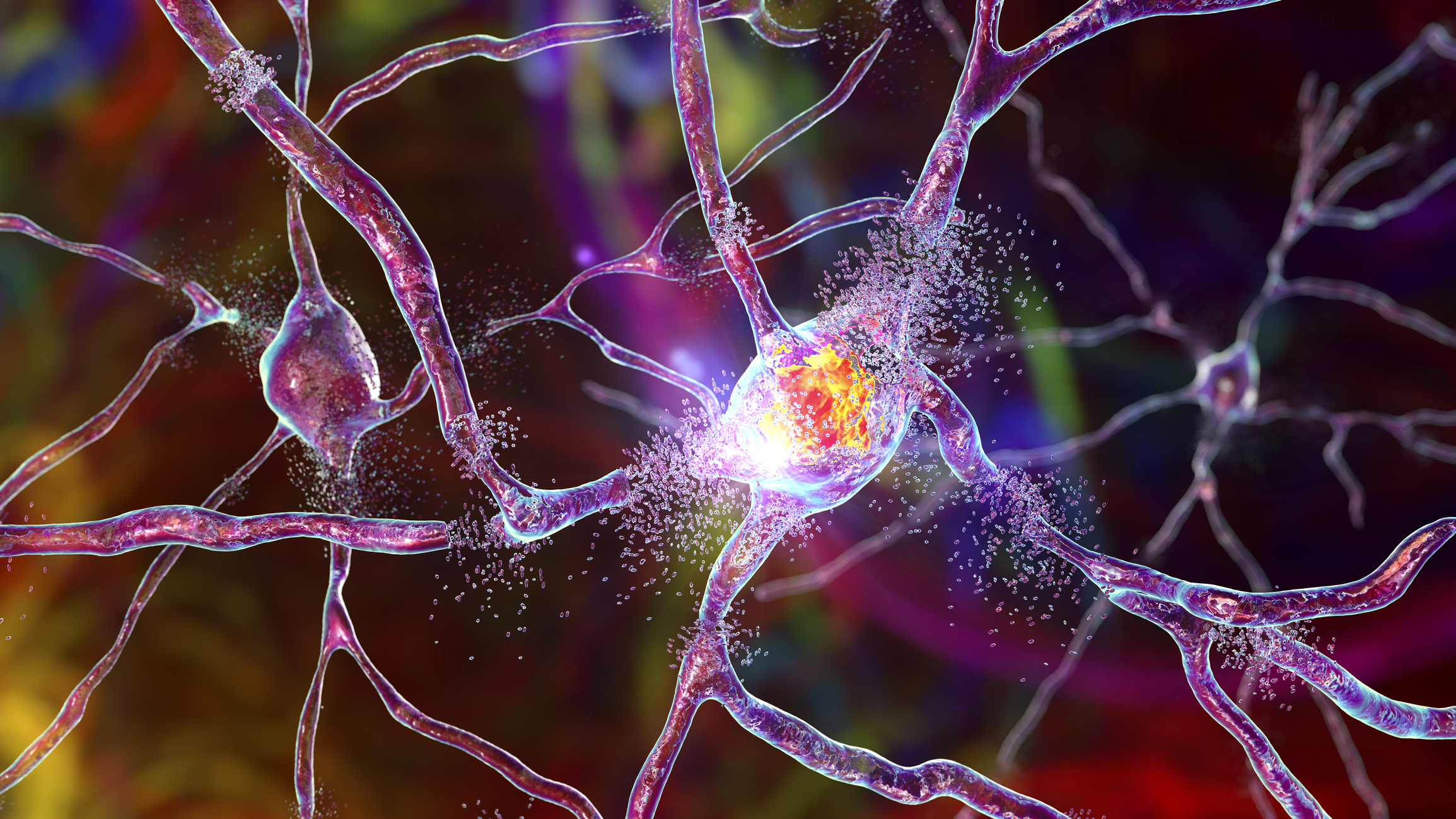 3D illustration of the destruction of neurons in the dorsal striatum