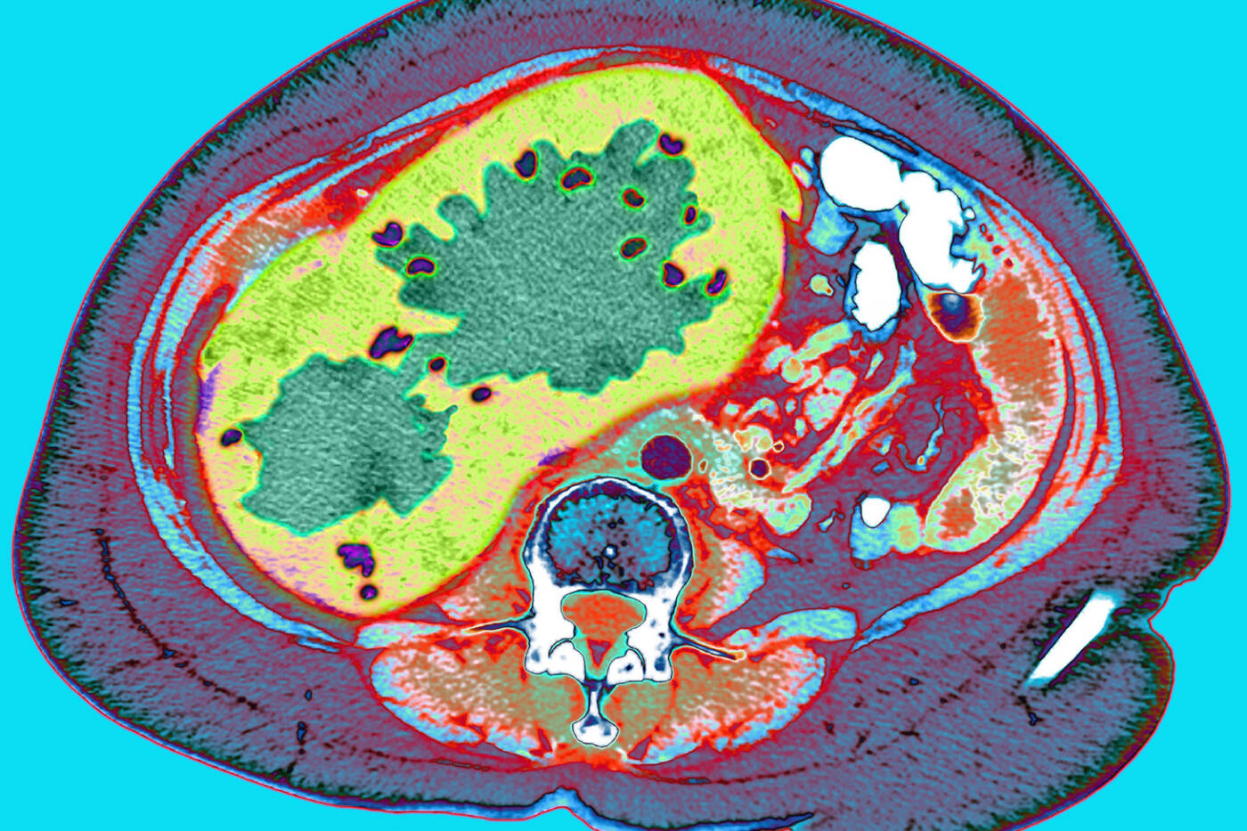 Multicolored CT scan through a cancerous liver
