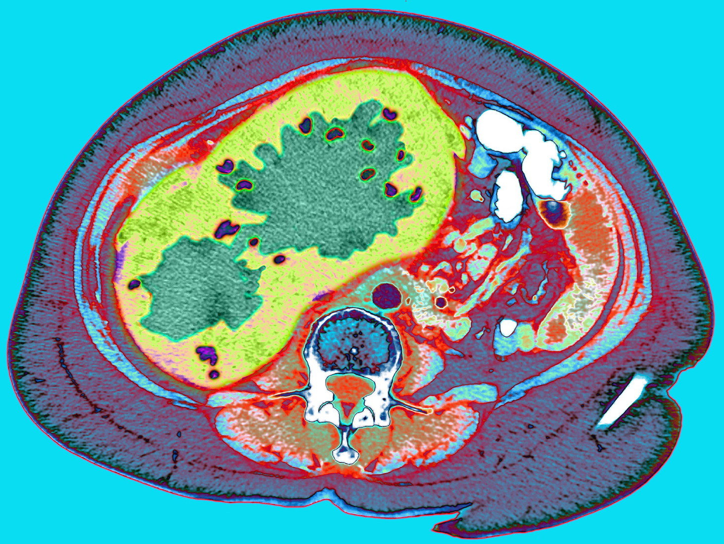 Multicolored CT scan through a cancerous liver