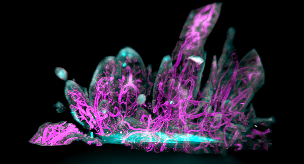 abnormal synovial tissue in magenta and cyan