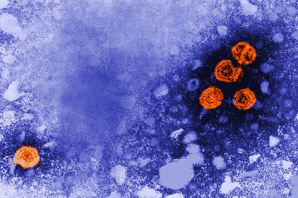 Transmission electron microscopic image showing hepatitis B virus virions in orange.