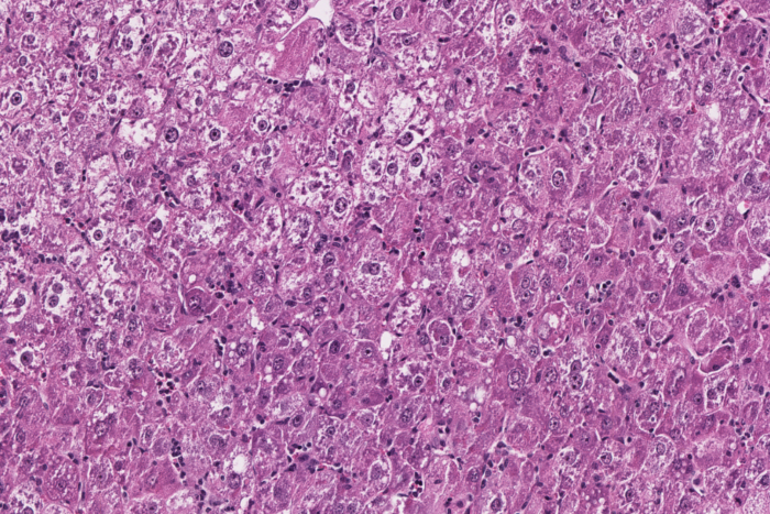Histology of a well-differentiated liver tumor in a mouse model.
