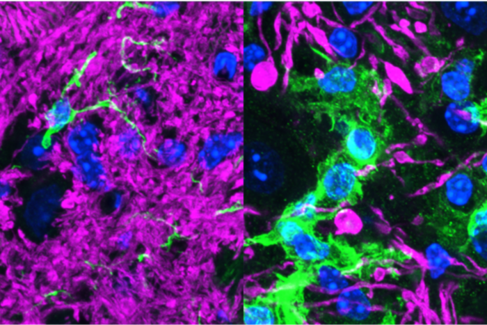 Left: Nerve fibers from healthy brain tissue are shown in magenta with support cells called glia in green. Right: Neurons deprived of PI31 are swollen and damaged.  Glia are activated and enlarged as they try to remove faulty connections between cells. (Credit: Steller lab)