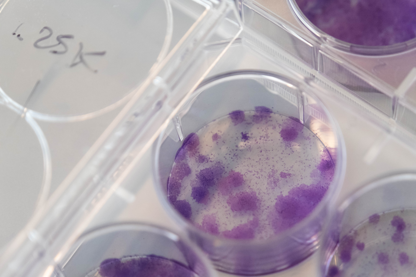 Researchers show how the senescent state induced by sarcoma and breast cancer drugs drives inflammation.