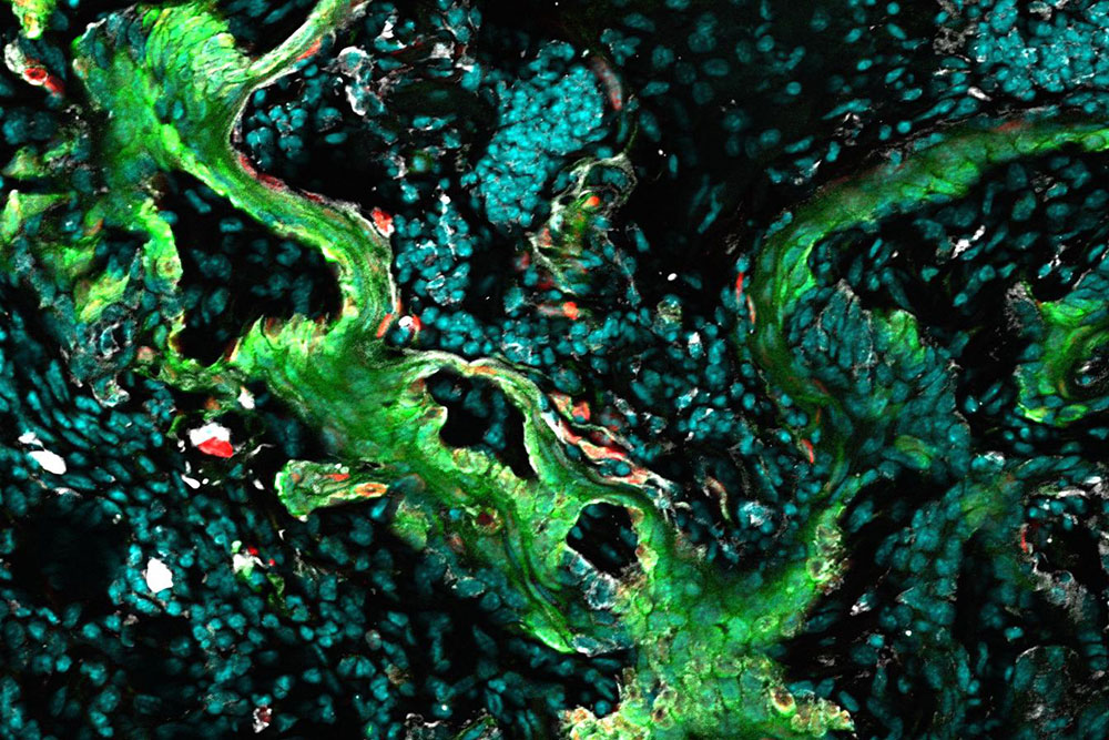 squamous cell carcinoma