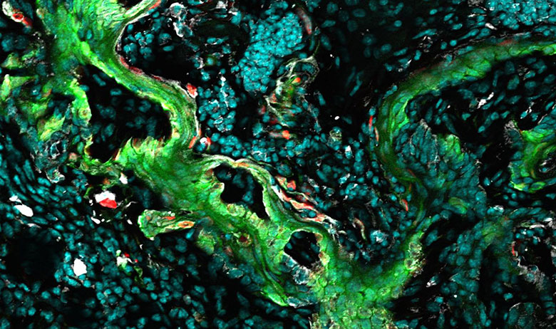 squamous carcinoma cells
