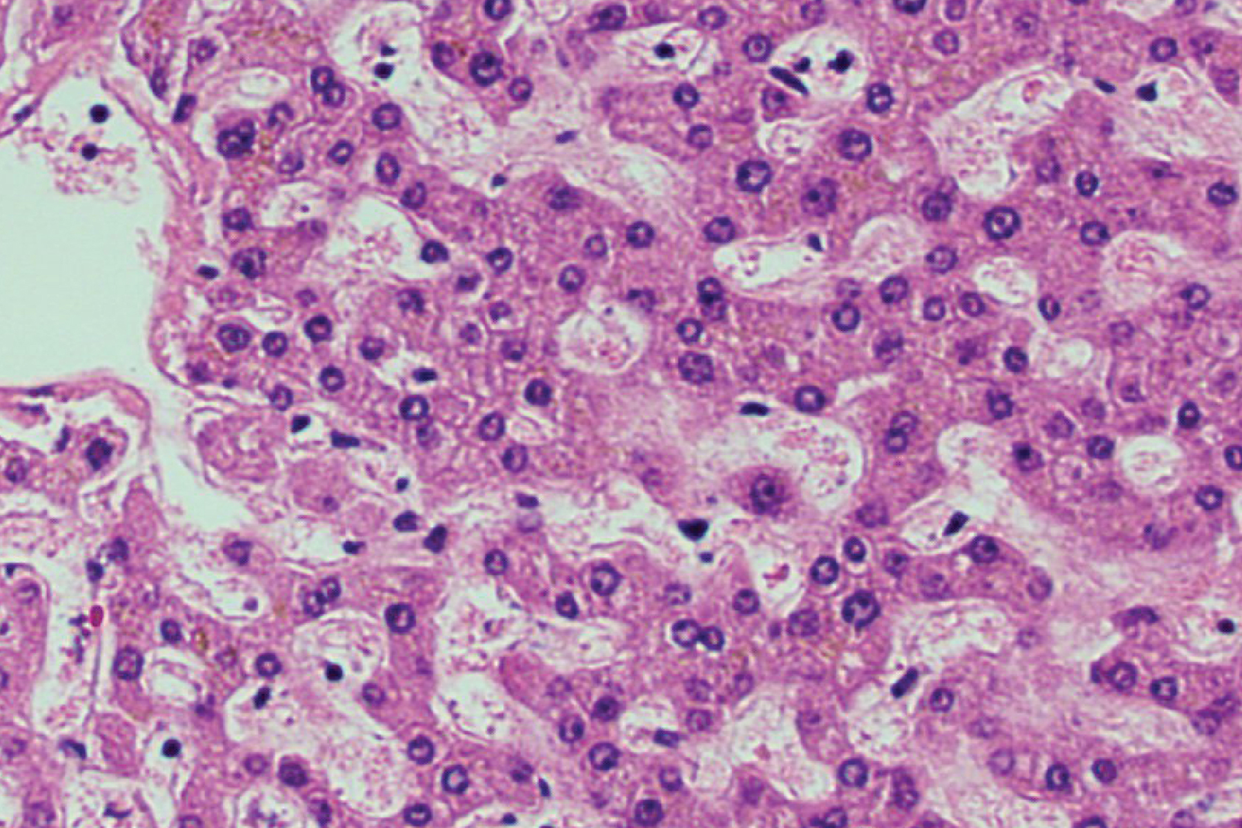 New study points the way to therapy for rare cancer that targets the young