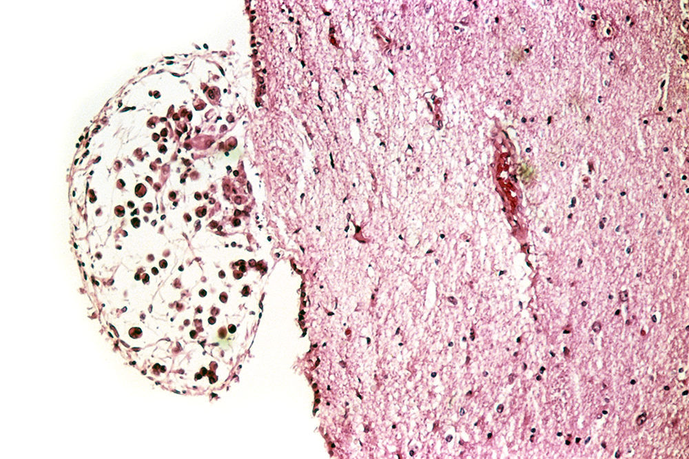 A cross section of a metastatic brain tumor from a patient