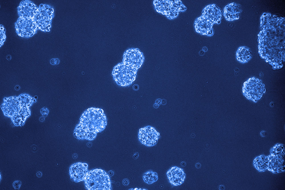 DIPG cells, pictured here, are generally resilient and replicate rapidly. With a dose of MI-2, however, the cells abruptly die.