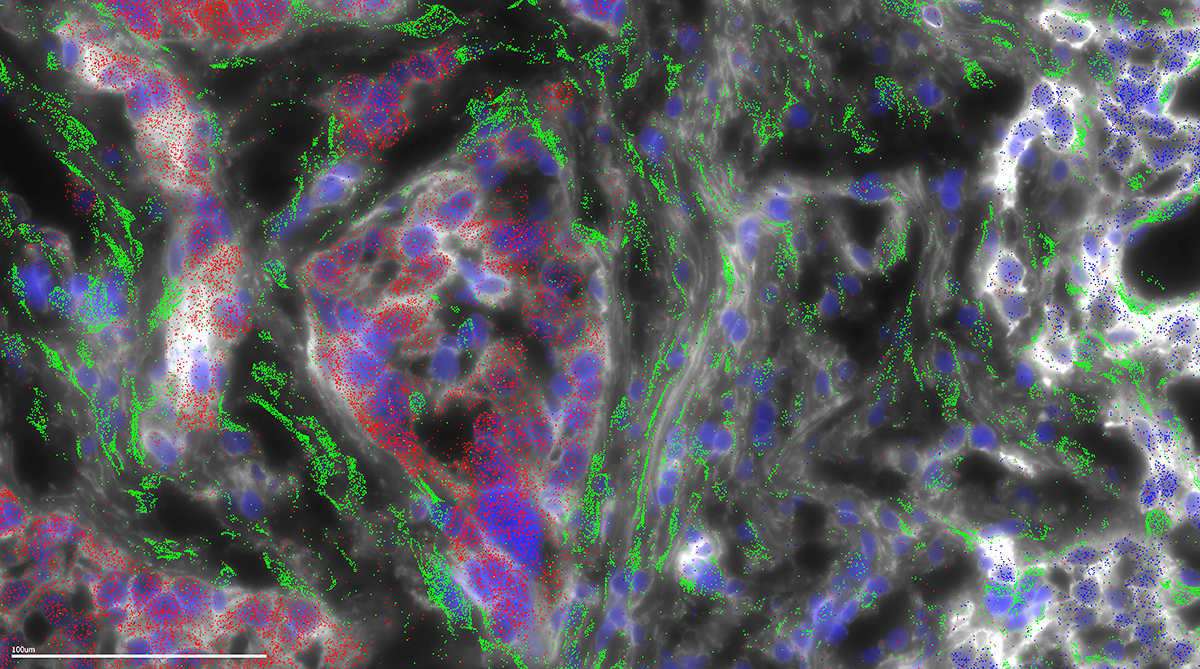 A deep view of FLC tumor tissue in blue, red, and green