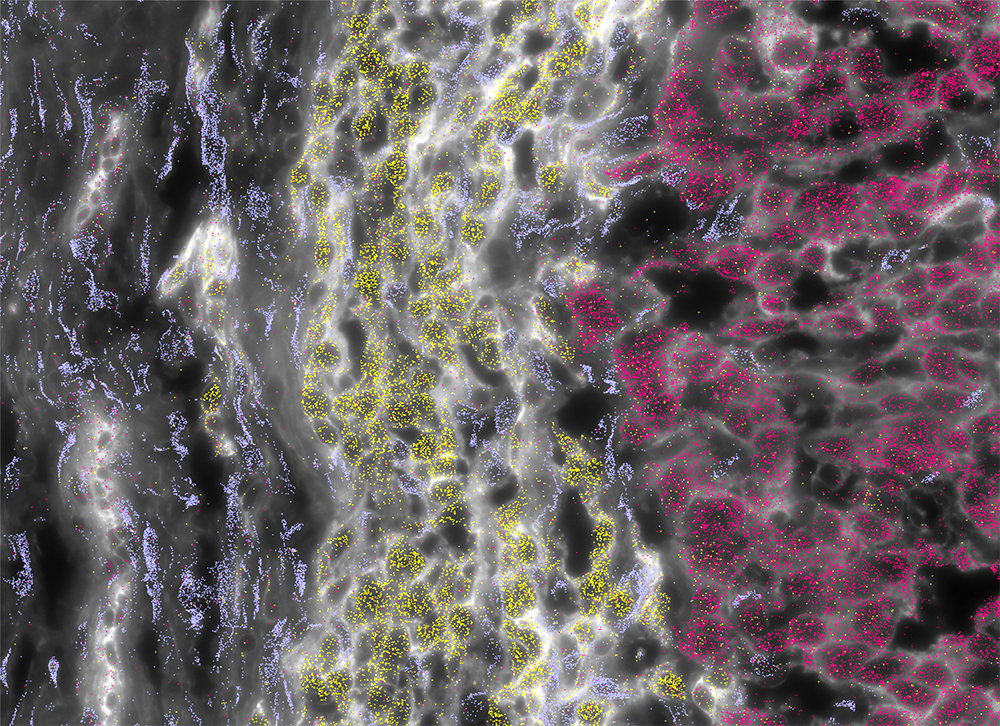 Histological section of an FLC tumor, showing the stromal (left), normal (center), and tumor (right) cells. The colors correspond to gene markers identified for different cell types.