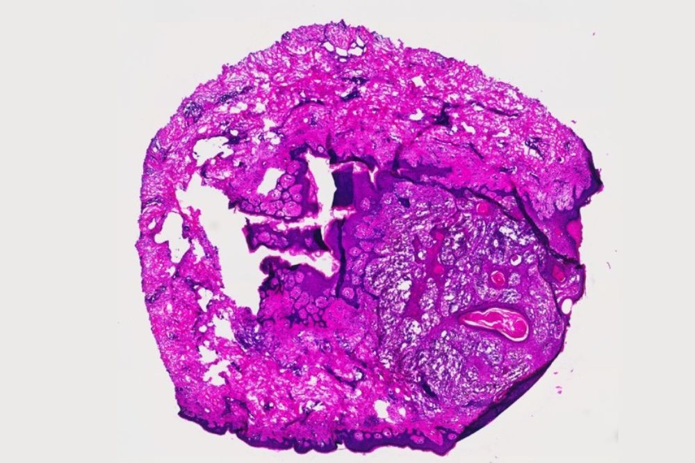 Histology image of a patient whose metastatic cancer went into complete remission after receiving a new immunotherapy treatment